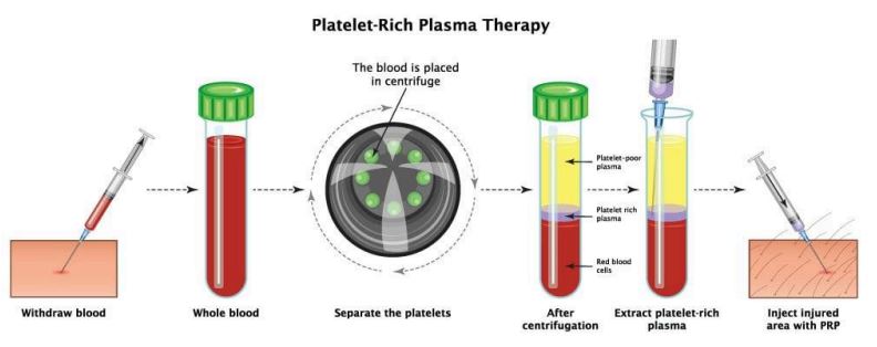 Platelet-Rich Plasma (PRP) therapy