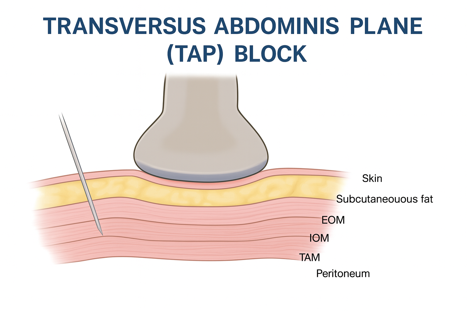 transversus adominis plane-block