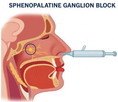 Sphenopalatine Ganglion (SPG) Nerve Block