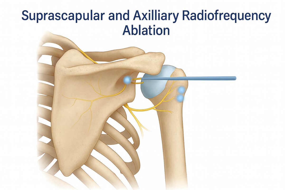 Si Rfa Cpt Code Suprascapular Nerve and Shoulder Joint Radiofrequency Ablation
